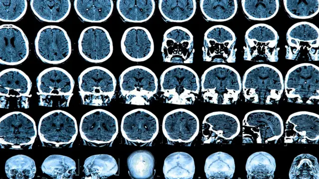 imagen de rayos X de un cerebro humano 