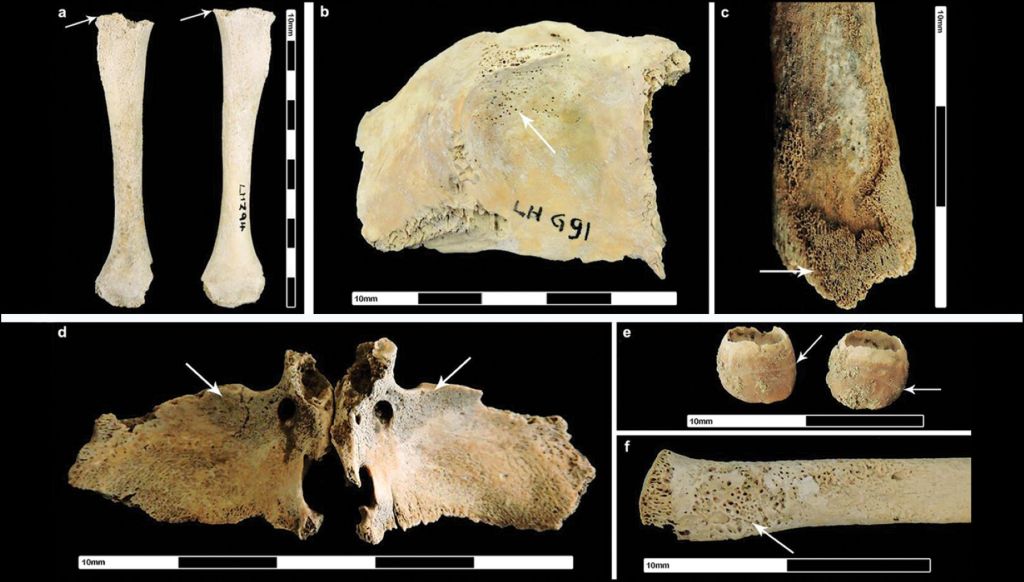 Patologías en los restos óseos de individuos no adultos de Britania