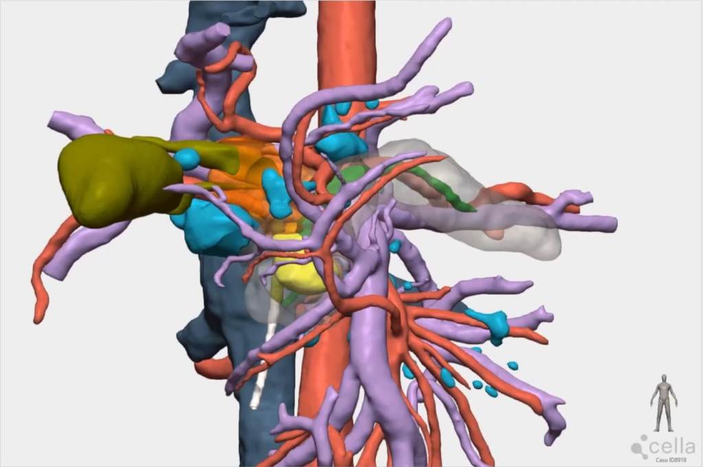 Planificación quirúrgica personalizada: cómo los modelos 3D pueden ayudar a planificar tu cirugía
