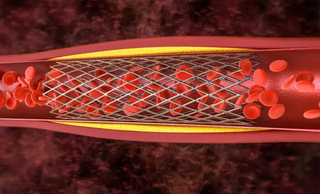 Ilustración de una arteria con un stent y sangre pasando gracias a ello.