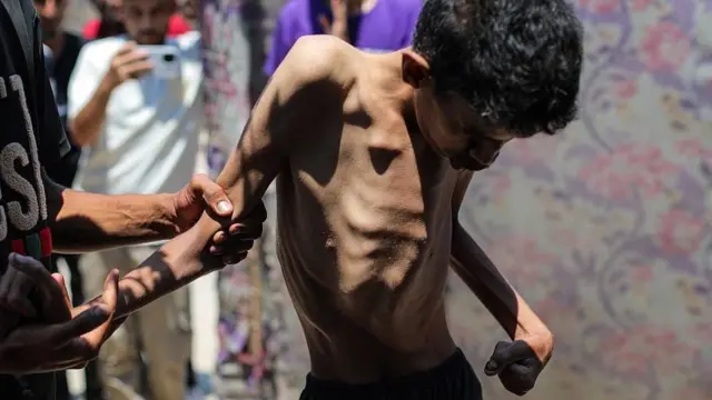 Hamza Mishmish, de 25 años, en condiciones extremas de desnutrición