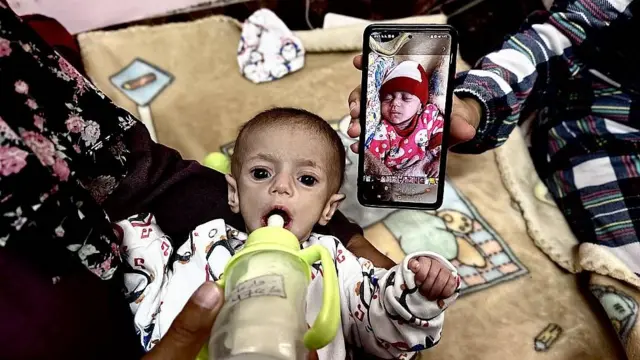 Suwar Ashur, de 5 meses, recibe tratamiento por desnutrición en el Hospital Nasser en Khan Yunis, Gaza, el 1 de mayo de 2025.