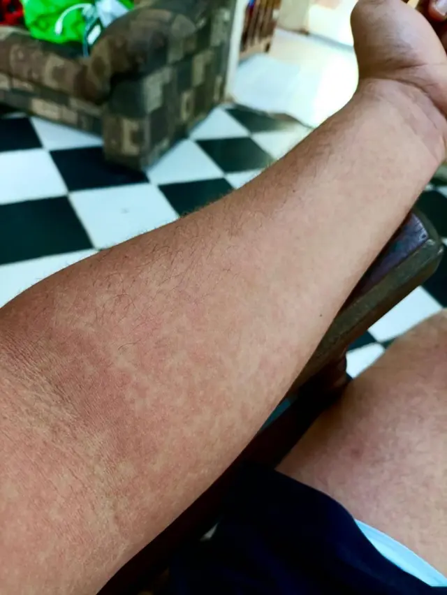 Brazo con sarpullido de Hansel