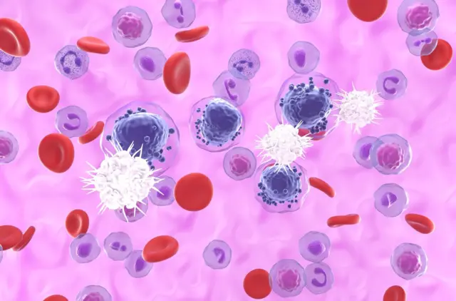 Ilustración de células dendríticas (blancas) que reconocen células cancerosas de leucemia mieloide aguda (LMA) (violeta)
