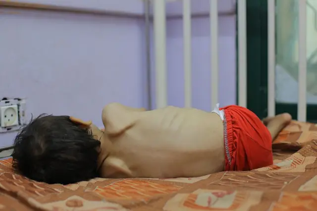 Niño desnutrido en Gaza.