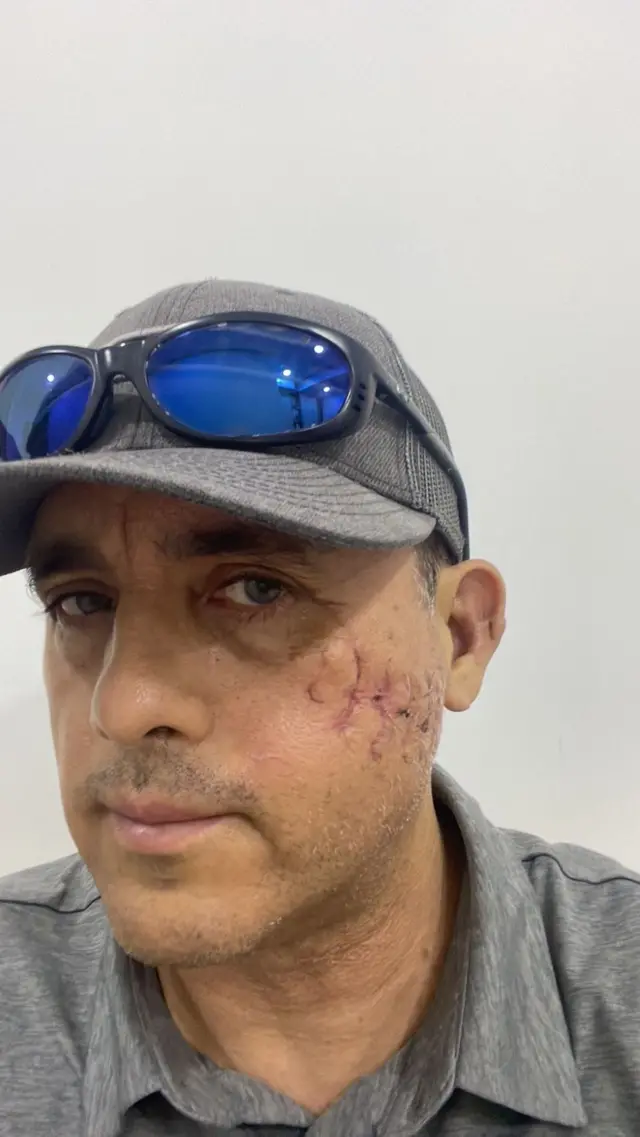 Mauricio muestra la cicatriz que le quedó en el rostro después del encuentro con el tiburón galápagos. 