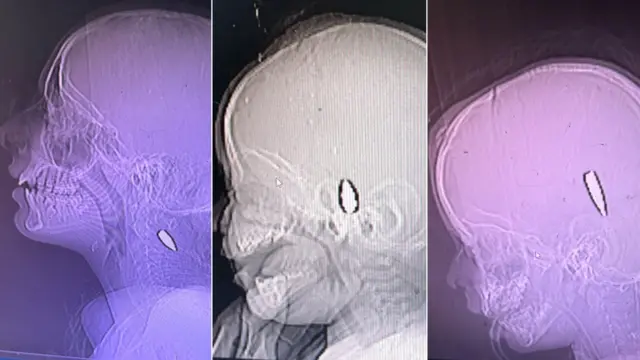 Tres imágenes de escáneres médicos que muestran las cabezas de unos niños: se puede ver una bala en el cuello del primero, en la parte inferior central de la cabeza del segundo y justo encima de la oreja en la cabeza del tercero.