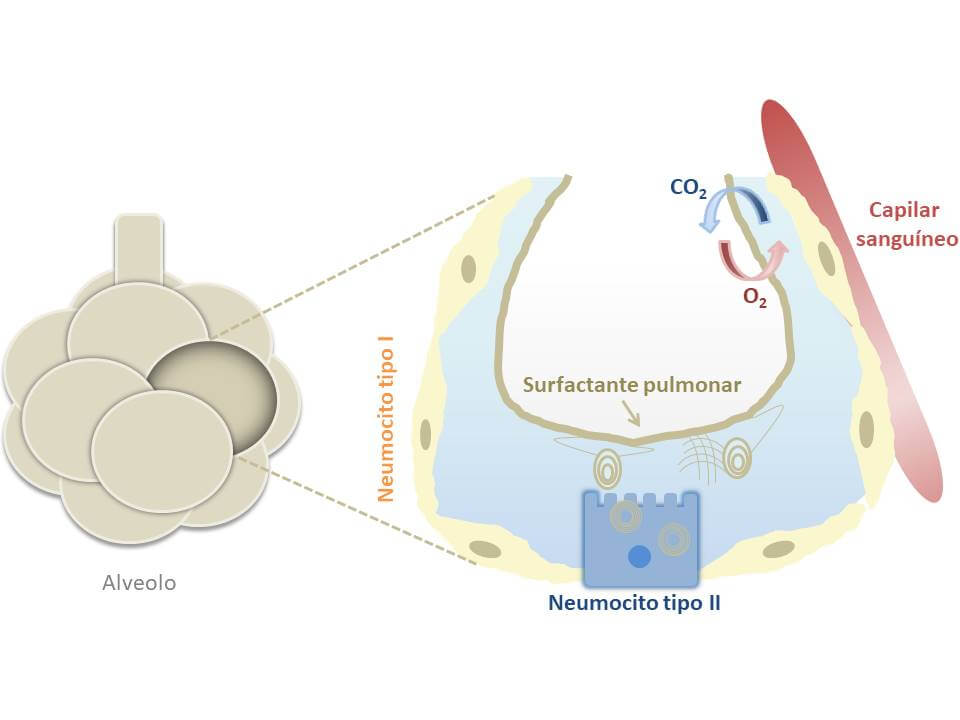 Figura 2. Ampliación de un alvéolo y localización del surfactante pulmonar. El surfactante pulmonar se forma en las células alveolares llamadas neumocitos tipo II y se secreta, llegando hasta la interfase aire-líquido, donde se distribuye de forma que la recubre completamente, permitiendo así el proceso de la respiración. Créditos: creación propia.