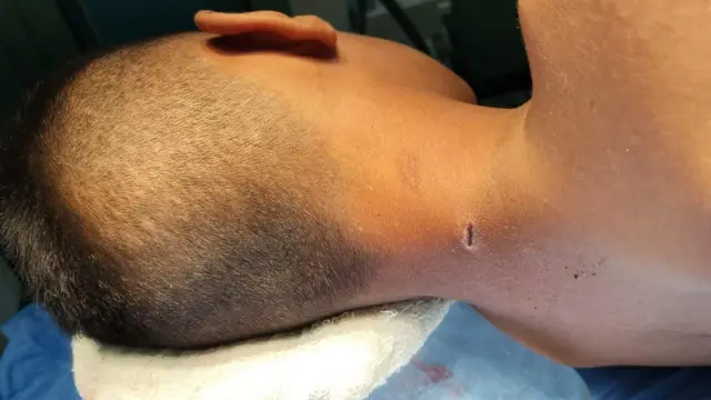 Una foto de la cabeza, el cuello y los hombros de un adolescente varón, tumbado de lado con la cabeza apoyada. Se puede ver una pequeña herida en forma de corte en la parte posterior del cuello.