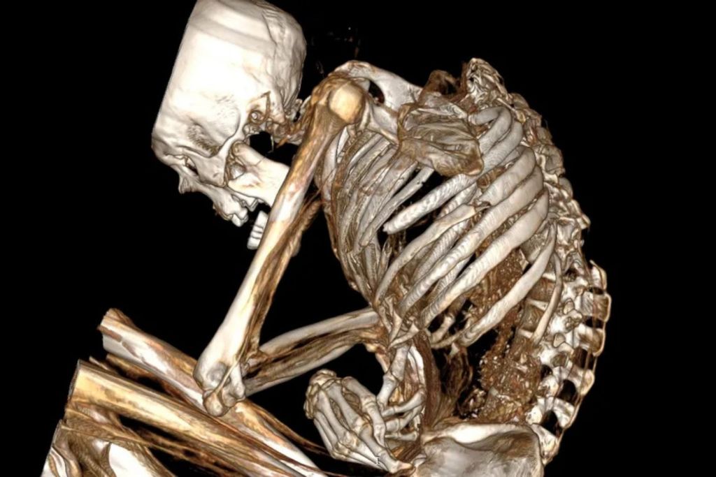 La tomografía permitió detectar lesiones graves en todo su cuerpo: desde la espalda y las costillas hasta las clavículas, los omóplatos y los huesos de las piernas, señal de un impacto devastador