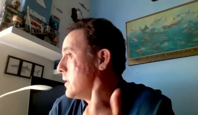 Mauricio Hoyos muestra la cicatriz que le dejó en la mejilla el ataque de un tiburón galápagos.