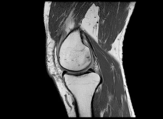 Rodilla rodeada de músculos. 
