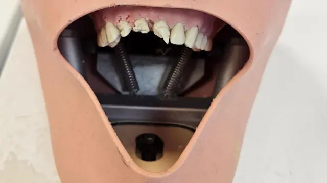 Modelo de una boca con tres dientes con caries