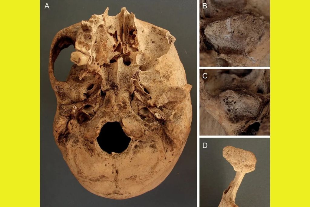 El cráneo de uno de los escribas analizados en el estudio presentaba signos de osteoartritis, además de desgaste y daños en varias áreas de la mandíbula