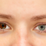 La heterocromía es una condición en la que los ojos de una persona tienen diferentes colores.