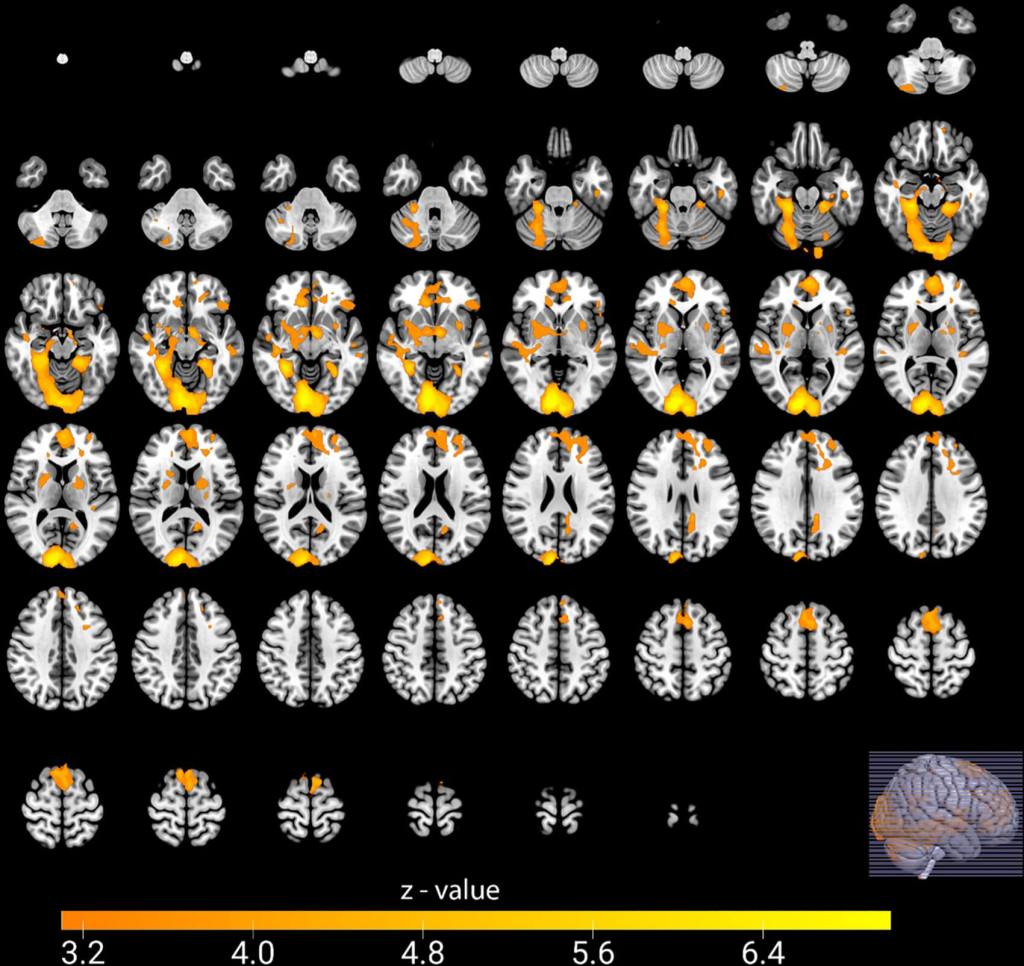 Actividad cerebral durante una victoria significativa: el mapa muestra cómo se activa el cerebro de los hinchas cuando su equipo marca al archirrival en comparación con un gol ante un equipo no rival. Créditos: RSNA / Radiology.
