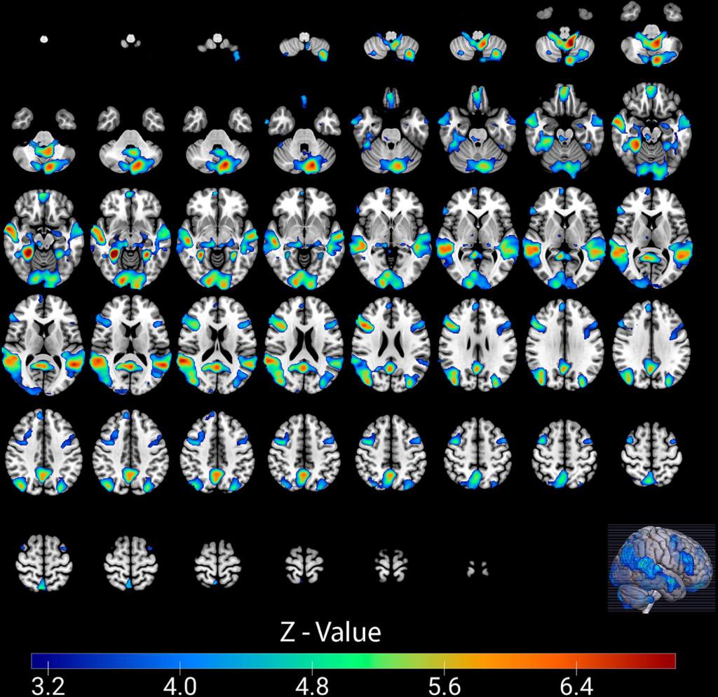 Actividad cerebral durante una derrota significativa: el mapa muestra cómo reacciona el cerebro de los hinchas cuando su equipo recibe un gol del archirrival frente a uno de un equipo no rival. Créditos: RSNA / Radiology.