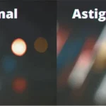 El astigmatismo es una condición tratable.